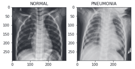 Pneumonia figure 1